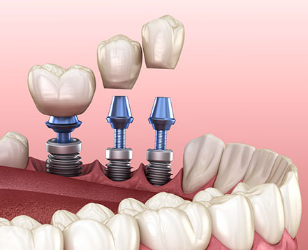 Dental Implants Noosaville